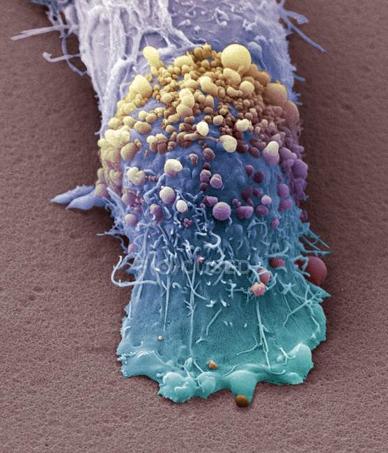 Skin cancer cell — Stock Photo