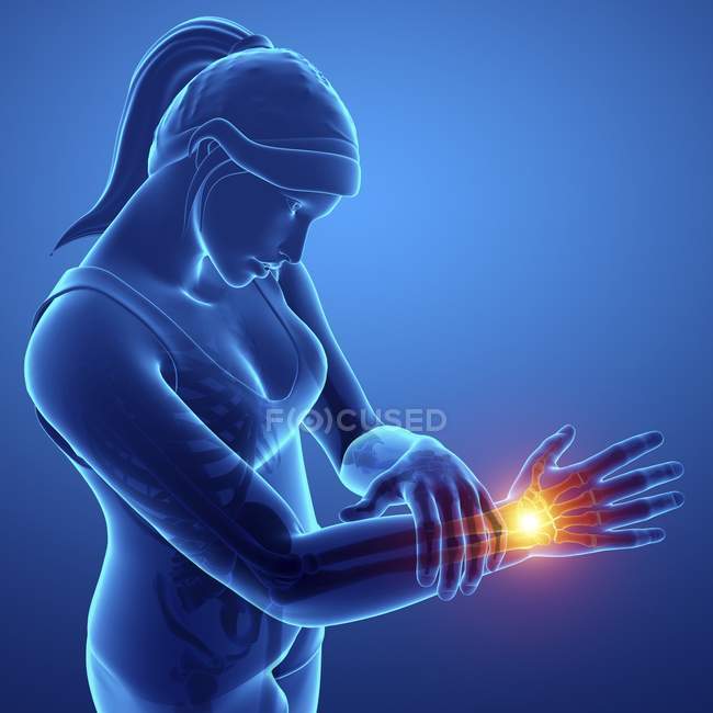 Female silhouette with wrist pain, digital illustration. — Stock Photo