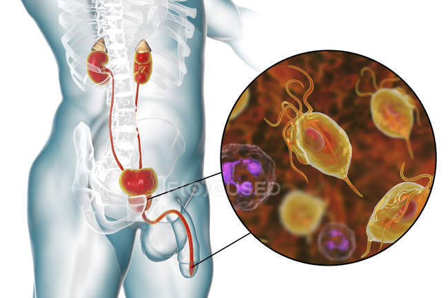 Illustration of male urinary system and parasitic Trichomonas vaginalis causing trichomoniasis. — Stock Photo