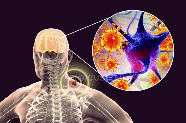 Human silhouette and tick-borne encephalitis, digital illustration. — Stock Photo