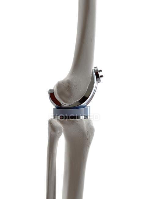 Illustration of knee replacement prosthesis on white background. — Stock Photo