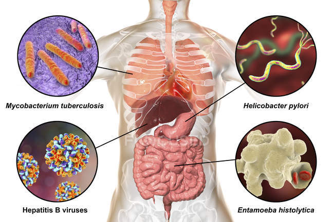 Digital labelled illustration showing bacteria causing infections of respiratory and digestive system, Mycobacterium tuberculosis, Helicobacter pylori, Hepatitis B viruses, Entamoeba histolytica. — Stock Photo