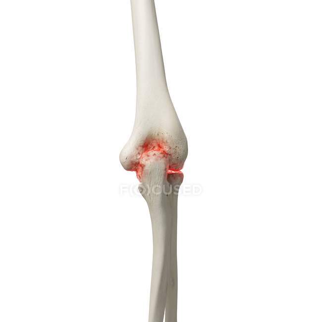 Realistic digital illustration showing arthritis in human elbow. — Stock Photo