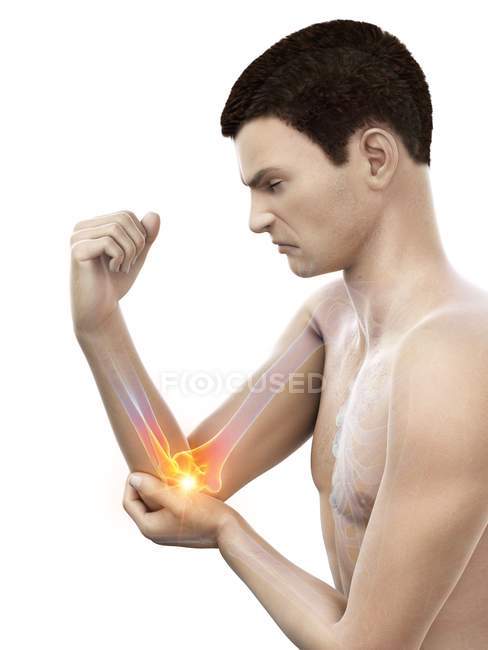 Abstract male body with visible elbow pain, conceptual illustration. — Stock Photo