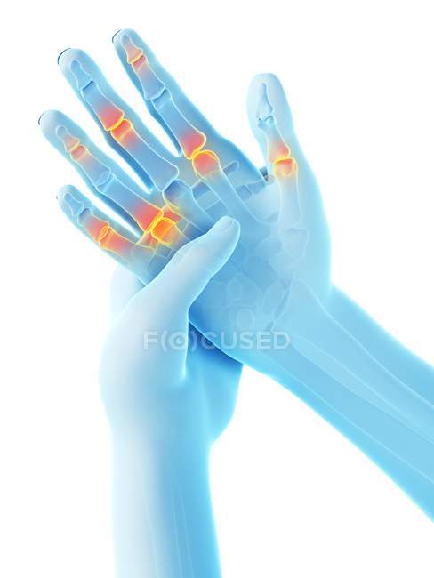 Abstract human hands with finger pain, conceptual illustration. — Stock Photo