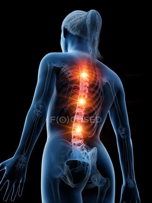 Female silhouette with glowing back pain, conceptual digital illustration. — Stock Photo