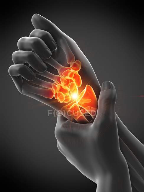 Abstract human hands with wrist pain, conceptual illustration. — Stock Photo