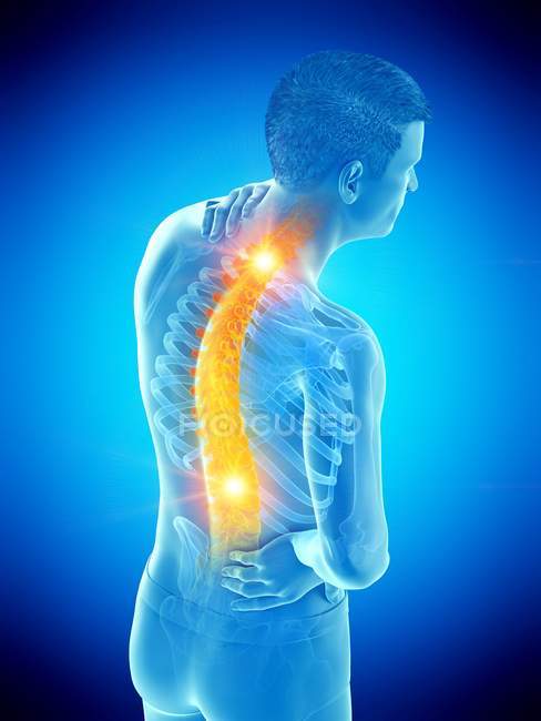 Male silhouette with back pain in high angle view, conceptual illustration. — Stock Photo