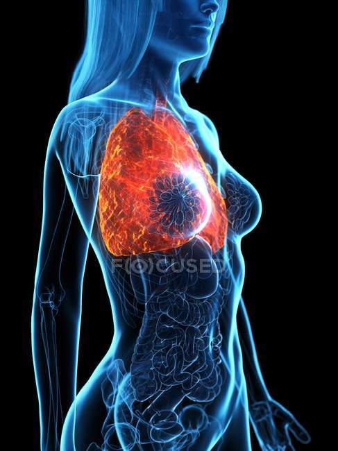 Diseased lungs in transparent female body on black background, computer illustration. — Stock Photo