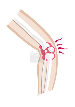 Illustration for Cross cut Isolated on white diagram of an injured knee - Royalty Free Image