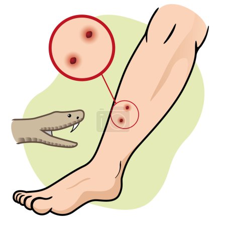 Illustration for Illustration First Aid person chopped leg snake. Ideal for catalogs, informative and medical guides - Royalty Free Image