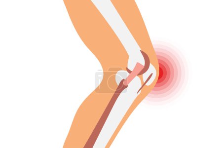 Illustration for Knee pain illustration. Pain circle on a knee joint. Medicine concept. - Royalty Free Image