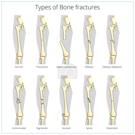 Illustration for Types of bone fractures medical skeleton anatomy educational vector illustration. Medical science - Royalty Free Image