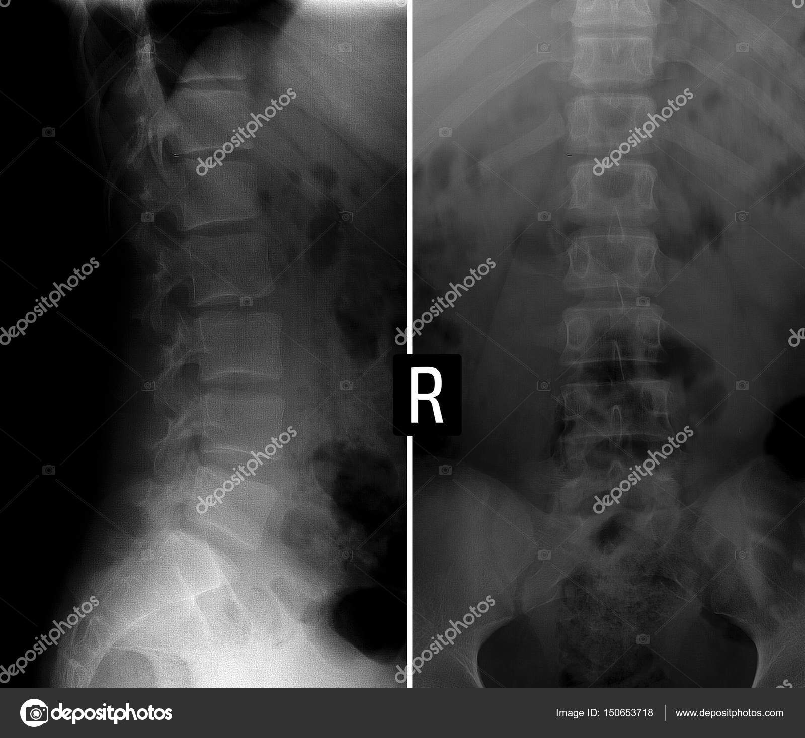 X-ray of the lumbar spine. Wedge-shaped deformed body of the vertebra ...