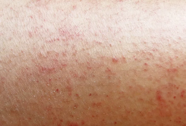 Rash on sensitive skin