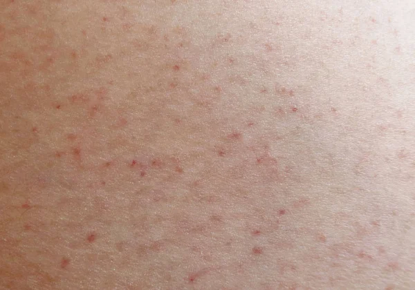 Rash on sensitive skin