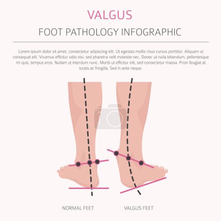 Illustration for Foot deformation as medical desease infographic. Valgus and varus defect. Vector illustration - Royalty Free Image