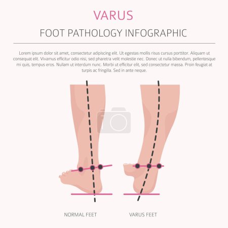 Illustration for Foot deformation as medical desease infographic. Valgus and varus defect. Vector illustration - Royalty Free Image