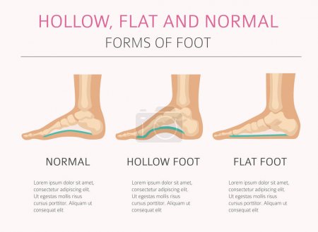 Illustration for Foot deformation types,  medical desease infographic. Hollow, flat and normal foot. Vector illustration - Royalty Free Image