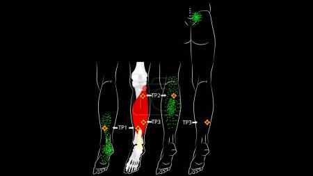 Illustration for Soleus muscle. Trigger points and reflected leg pain. - Royalty Free Image