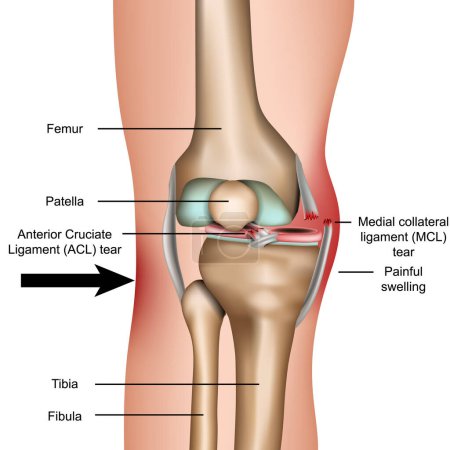 Illustration for Dislocated knee, medial collateral ligament tear medical vector illustration isolated on white background - Royalty Free Image