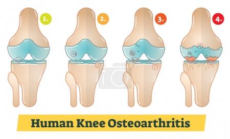 Illustration for Human Knee Osteoarthritis vector diagram illustration - Royalty Free Image