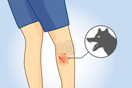 Illustration for Dog bite wounds on calf leg. Rear view. Illustration about medical and first aid. - Royalty Free Image