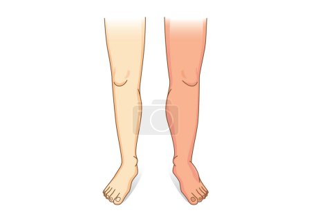 Illustration for Human Leg swelling in front view. Illustration about the diseases and conditions of fluid gathers in foot and leg. - Royalty Free Image