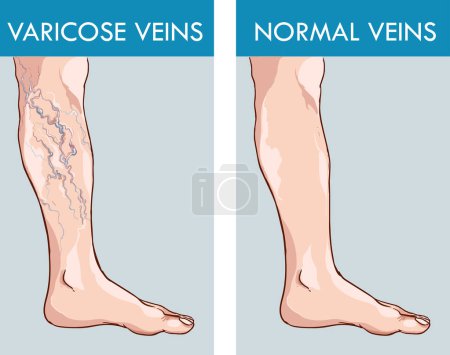 Illustration for Illustration of a healthy leg and the affected varicose veins - Royalty Free Image