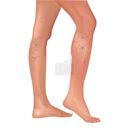 Illustration for Varicose veins in the legs. Vascular or spider veins. Vector illustration. - Royalty Free Image