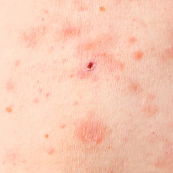 skin rash treatment on woman body. Shingles, Disease, Herpes zoster, varicella-zoster virus. skin rash and blisters on body