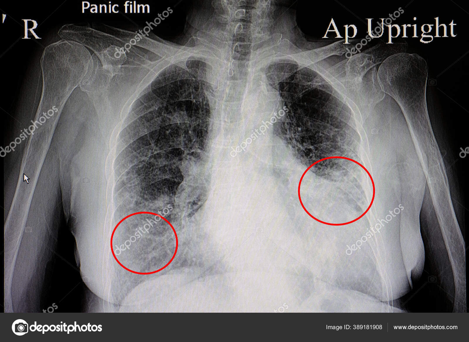 Chest Ray Film Female Patient Showing Cardiomegaly Bilateral Pulmonary ...