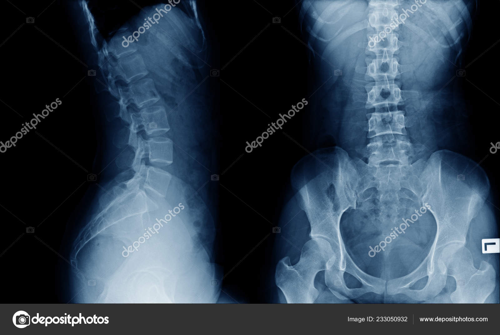 Back Ray Image Lateral View Blue Tone Black Background — Stock Photo ...