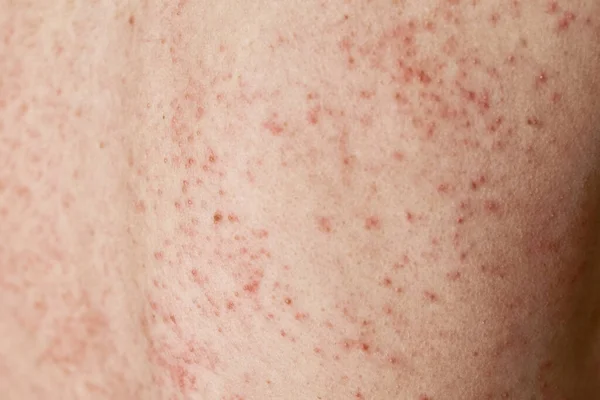 Allergic rash on the skin. Woman with dermatology problem on back skin