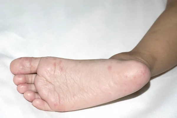 Allergic rash skin of baby\'s right foot