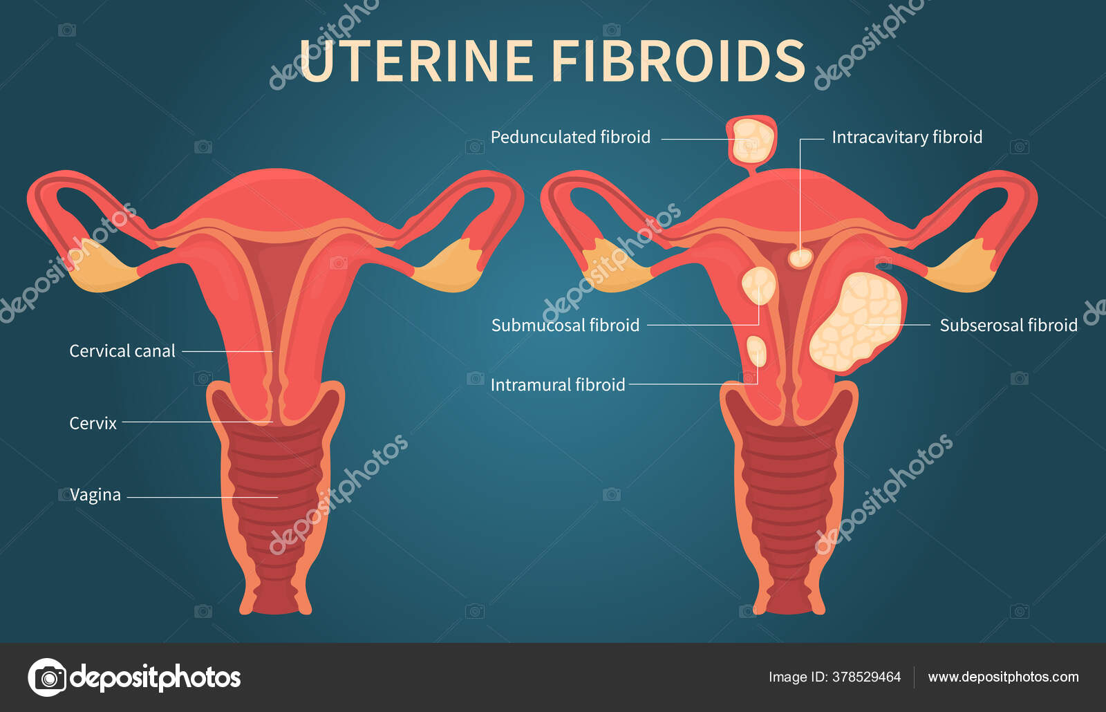 Uterine fibroids scheme on dark blue background Stock Vector by ...