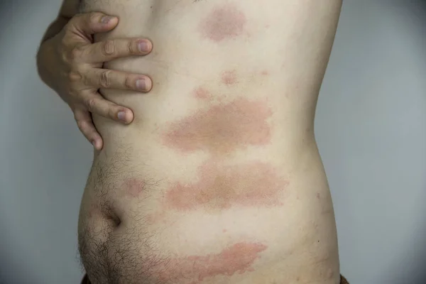 Man getting red skin rash at his body part - people with skin allergy problem concept