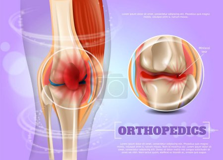 Illustration for Realistic Illustration Orthopedics Medicine in 3d. Banner Vector Image Closeup Anatomy and Structure Human Knee Joint. Infographics Study Rupture and Treatment Methods Miniscal Tear - Royalty Free Image