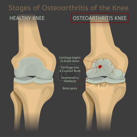 Illustration for Stages of osteoarthritis of the knee. Editable vector illustration in realistic style isolated on a dark grey background. Medical, healthcare and physiology concept. Scientific infographic. - Royalty Free Image