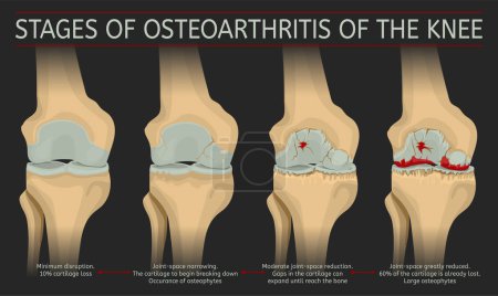 Illustration for Stages of osteoarthritis of the knee. Editable vector illustration in realistic style isolated on a dark grey background. Medical, healthcare and physiology concept. Scientific infographic. - Royalty Free Image