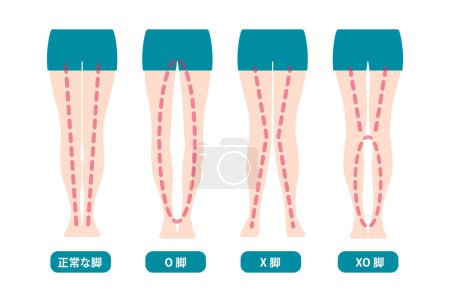 Illustration for Difference types of legs angles and knees vector illustration (Japanese) - Royalty Free Image