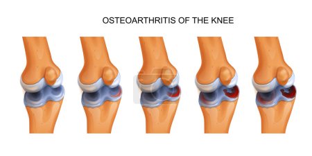 Illustration for Vector illustration of osteoarthritis of the knee - Royalty Free Image