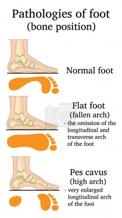 Illustration for Illustration of the location of bones in pathologies of the foot - Royalty Free Image