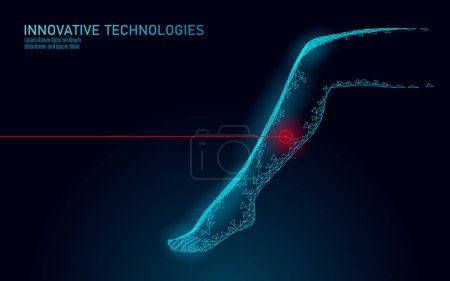 Illustration for 3D woman leg endovenous laser operation concept. Medical surgery veins varicose treatment female foot. Cosmetic hair laser depilation healthy massage salon care vector illustration. - Royalty Free Image