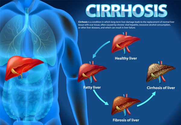 Stages Liver Disease Leading Cirrhosis Illustration Stock Vector by ...