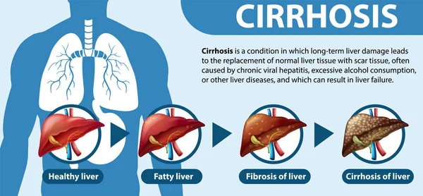 Stages Liver Disease Leading Cirrhosis Illustration Stock Vector by ...