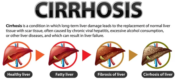 Stages Liver Disease Leading Cirrhosis Illustration Stock Vector by ...