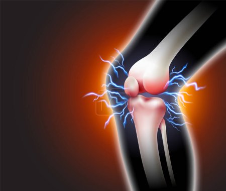 Illustration for Knee pain and pain throbbing into the bone Inflammatory disease of the knee joint on black background. Realistic 3d vector file. - Royalty Free Image