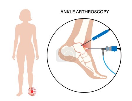 Illustration for Ankle arthroscopy procedure. Feet joint minimally invasive surgery concept. Arthroscope and arthroscopic instrument. Foot treatment, leg pain and inflammation. Anatomical x ray vector illustration - Royalty Free Image