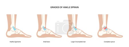 Illustration for Sprained ankle grades. Twisted feet, pain and swelling. Tears, stretch or rupture of ligaments. Foot trauma anatomical poster, diagnosis and treatment in clinic. Leg injury, X ray vector illustration - Royalty Free Image